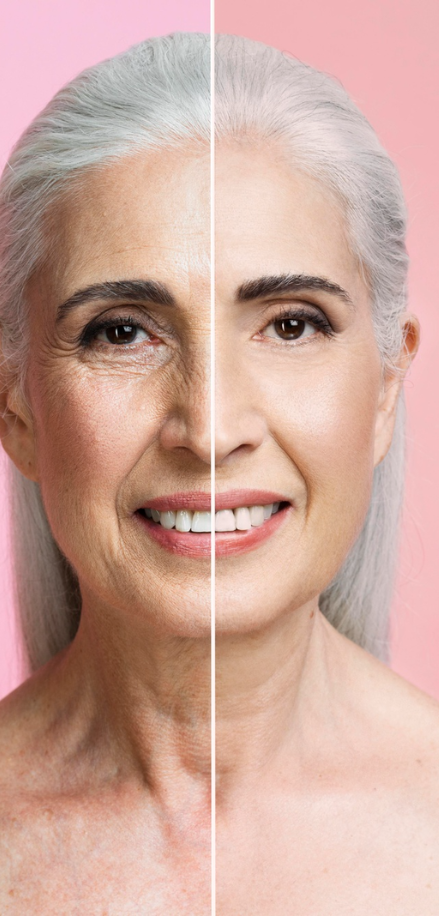 Ultherapy x Botox: Qual é o Melhor para Rejuvenescimento Facial?